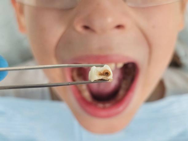 Best Emergency Tooth Extraction in Hooper, UT
